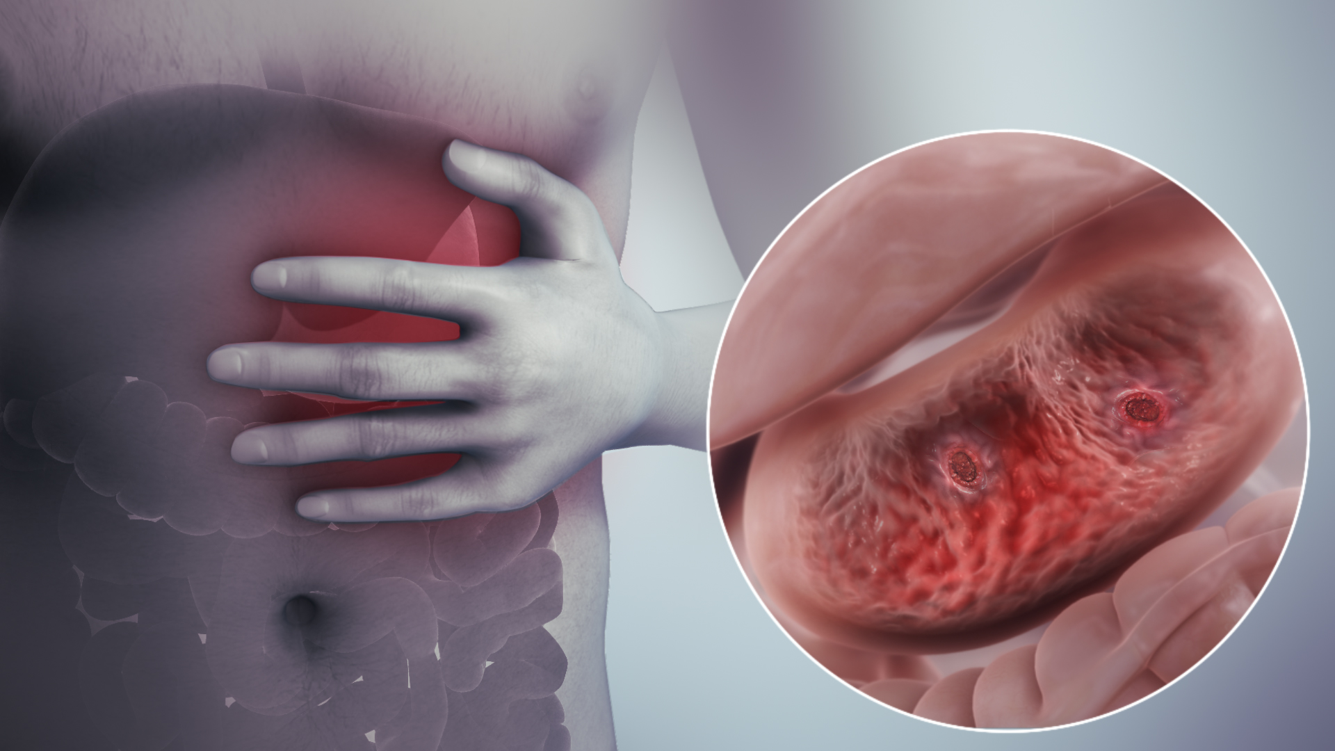 Stomach Ulcers treatment in Thane and Mulund